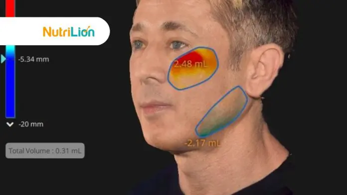 EMFACE 非侵入性瘦臉效果持久