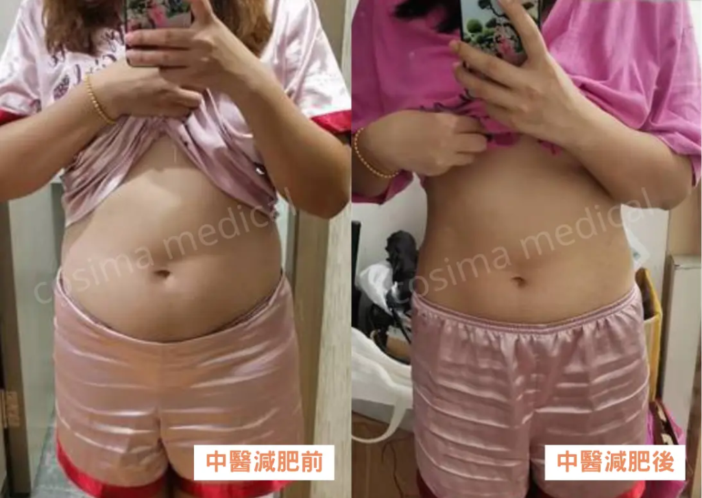 中醫減肥 - 個案二:32歲女婚前瘦身 中醫助減肚腩消水腫