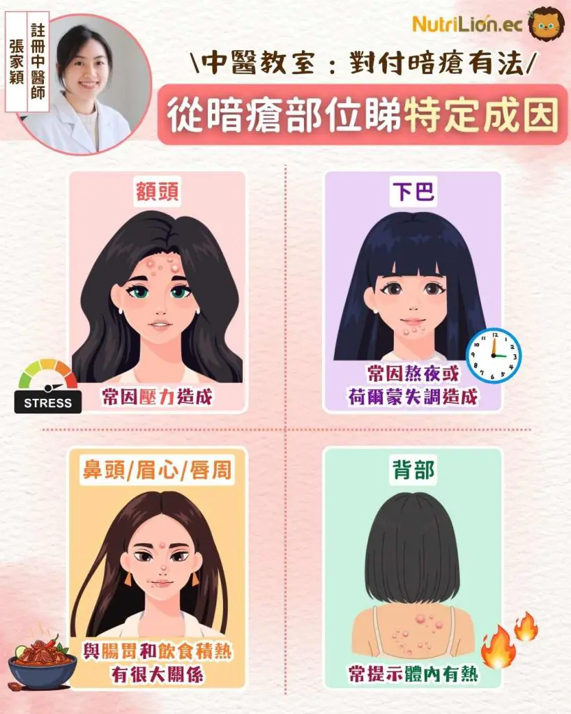中醫暗瘡|從暗瘡部位睇特定成因