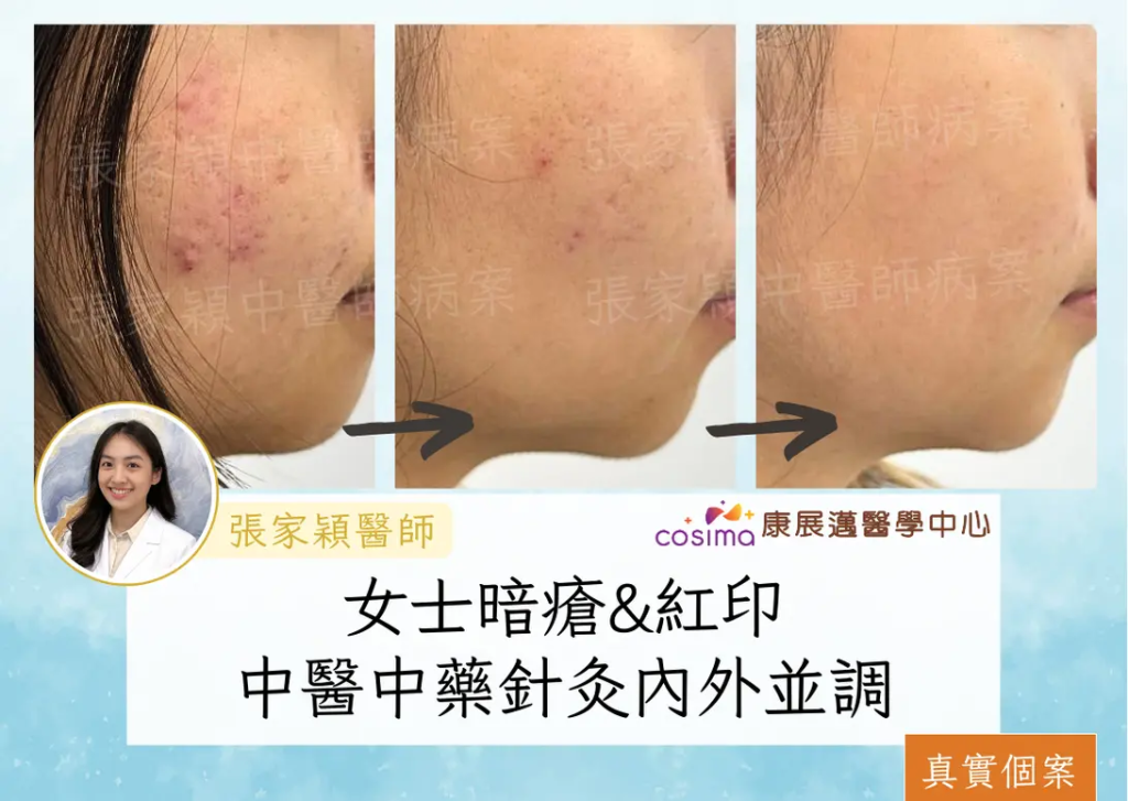 中醫暗瘡|真實個案分享:中醫中藥美顏針灸治療暗瘡 2星期回復平滑皮膚