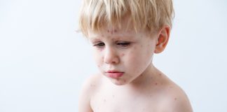 【水痘】成人也會被水痘傳染?拆解水痘症狀及預防方法! 水痘症狀