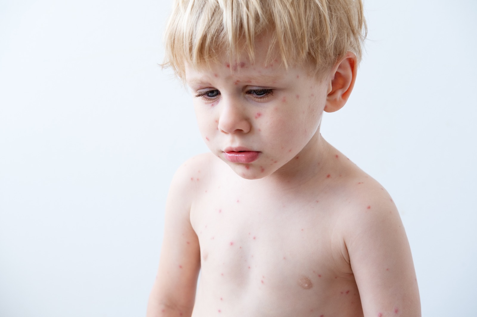 小男孩身上长了水痘。水痘是一种由水痘带状疱疹病毒引起的感染。它最初是起源于面部和躯干的水疱状皮疹照片摄影图片_ID:342846937-Veer图库