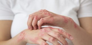 濕疹痕癢無比?教你不同濕疹穴位按摩法,讓你不再煩惱! 濕疹穴位