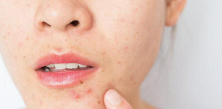 【暗瘡治療】暗瘡有什麼成因?可以擠暗瘡嗎?一文解答暗瘡問題!附戒口表、處理方法 【暗瘡治療】暗瘡有什麼成因?可以擠暗瘡嗎?一文解答暗瘡問題!附戒口表、處理方法