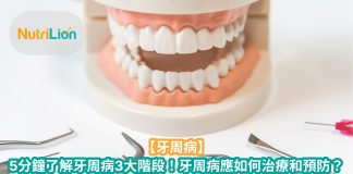【牙周病】5分鐘了解牙周病3大階段!牙周病應如何治療和預防? 【牙周病】5分鐘了解牙周病3大階段!牙周病應如何治療和預防?