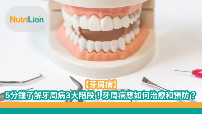 【牙周病】5分鐘了解牙周病3大階段！牙周病應如何治療和預防？