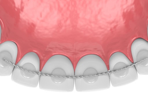 箍牙固定器種類：固定式舌側固定器