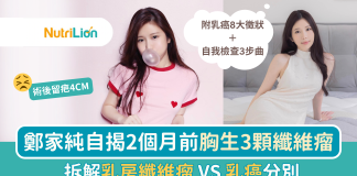 【乳房腫瘤】鄭家純自揭胸生3顆纖維瘤 術後留疤4CM|乳房纖維瘤VS乳癌分別 鄭家純乳房纖維瘤