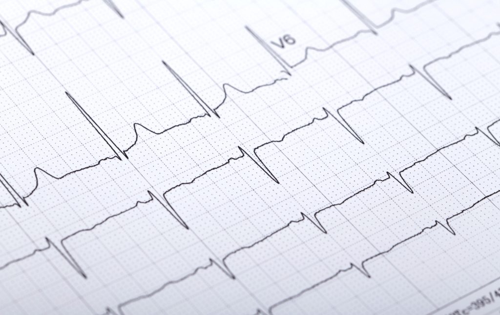 心口痛檢查種類 1：靜態心電圖（Electrocardiogram） 心電圖，是一種常見且基本的心臟檢查方法，其原理是紀錄心臟收縮和擴張過程中產生的微弱電流。當這種電流在全身流動時，可以透過貼在手和腳上的電極片將其傳輸到電流計，並以波形的方式記錄在紙帶上。心臟功能的任何改變都會在心電圖上顯示為異常。尤其在診斷心肌梗塞的時候，心電圖能明確指出心肌梗塞的位置。心臟科醫生可以根據心電圖上的波形變化來評估和診斷患者的病況。